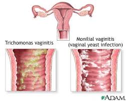  Yeast infection  is one common