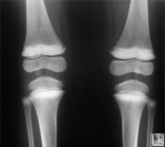 child with lead poisoning - via Daymix