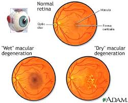  Macular degeneration 