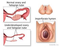  Primary amenorrhea 