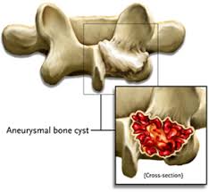 http://www.back.com/images/aneurysmal-bone-cyst-11-1.jpg