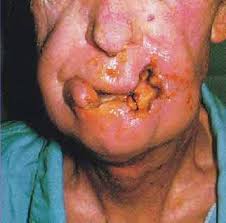 mouth_cancer_cr.jpg