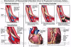 http://faculty.ksu.edu.sa/73698/Pictures%2520Library/myocardial%2520infarction%25202.bmp