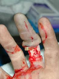 Degloved  Finger   from Ring    