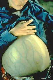  Hepatitis  B