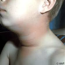 Mumps