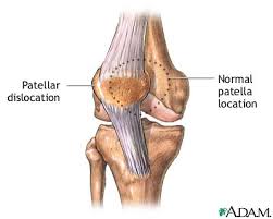 Dislocation  usually occurs as
