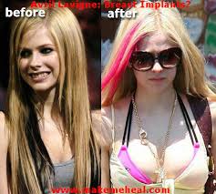 Image <b>Avril Lavigne</b>, Breast Augmentation Picture