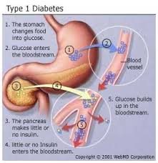  Type 1 Diabetes 