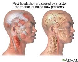relieve most  headaches .