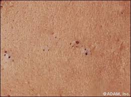 Blackheads ( comedones )