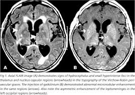 Opportunistic infections are - via Daymix