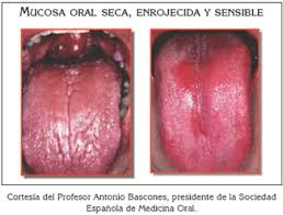http://www.intramed.net/UserFiles/imagenes/Xerostom%25C3%25ADa3.jpg