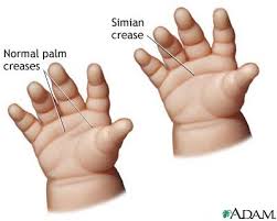  Aarskog syndrome  or fetal
