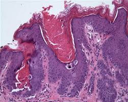 http://www.dermpathmd.com/photos/dariers_disease_atypical1_8.jpg