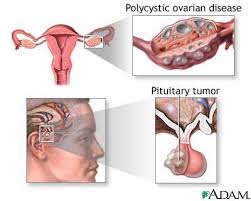  Secondary amenorrhea 