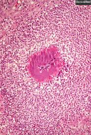 http://www.brown.edu/Courses/Digital_Path/systemic_path/pulmonary/L91.jpg