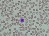 http://image.absoluteastronomy.com/images/topicimages/a/ab/abetalipoproteinemia.gif