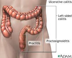 http://medicalimages.allrefer.com/large/ulcerative-colitis.jpg
