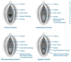 Types of Hymens: A Guide for