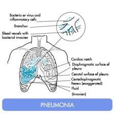 Bronchitis and  Pneumonia 