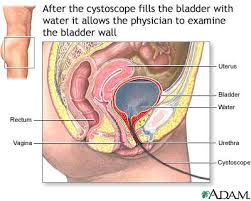  Cystoscopy 