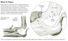  Tommy John surgery accomplishes, 