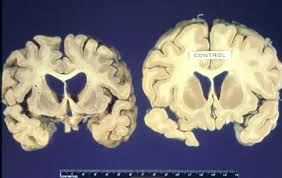 Mad Cow Disease Claims Suffolk - via Daymix