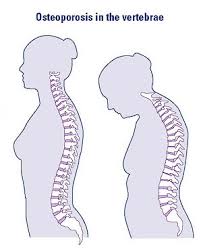 Osteoporosis in - via Daymix