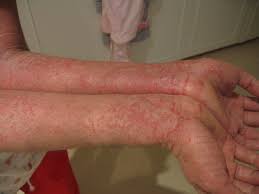  Eczema -arms.jpg&acirc;��