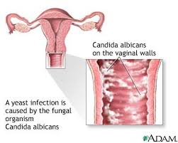 Yeast  infections 