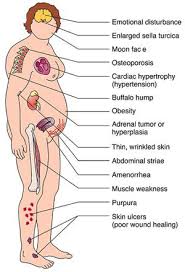 of  Cushing's syndrome .