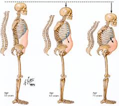 Osteoporosis in Men With - via Daymix