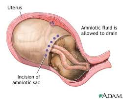 He then allows the  amniotic   fluid to    