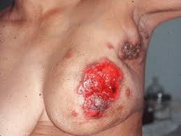 Breast_Cancer.gif