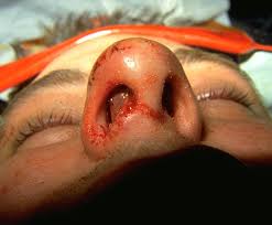  Septal hematoma 