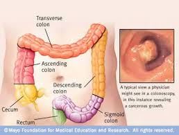 Colorectal Cancer Awareness