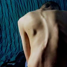 In scoliosis