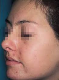 http://www.medicalwellnesscenter.com/AcneFaceGradeI.jpg