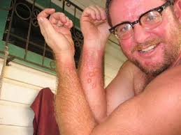  Allergic Reactions  to Wood