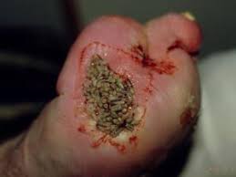 aureus (MRSA). - via Daymix