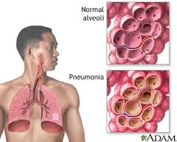  Pneumonia 