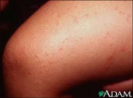 http://www.nlm.nih.gov/medlineplus/ency/images/ency/fullsize/2766.jpg