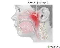  Adenoid removal  - series