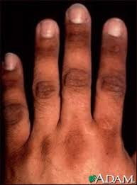 http://www.nlm.nih.gov/medlineplus/ency/images/ency/fullsize/2353.jpg