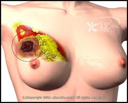  breast cancer  in new study