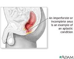 Aplastic  condition  