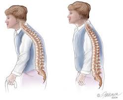 Prevent Osteoporosis - via Daymix