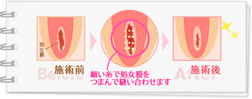 失った処女膜を再生したい。