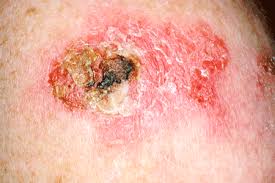 skin_cancer.gif